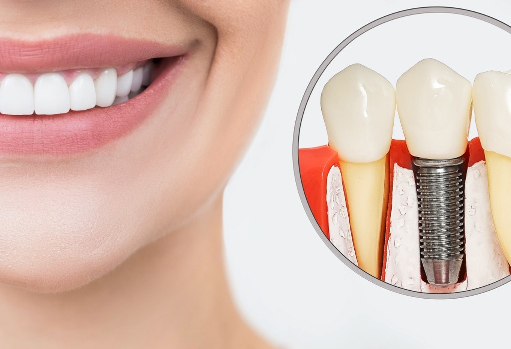 Dental Implants009_c