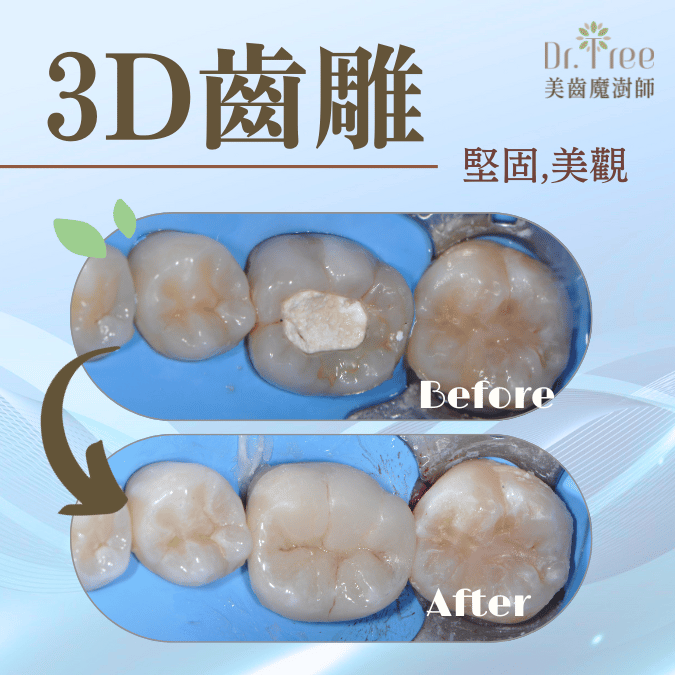 3D齒雕 丁先生