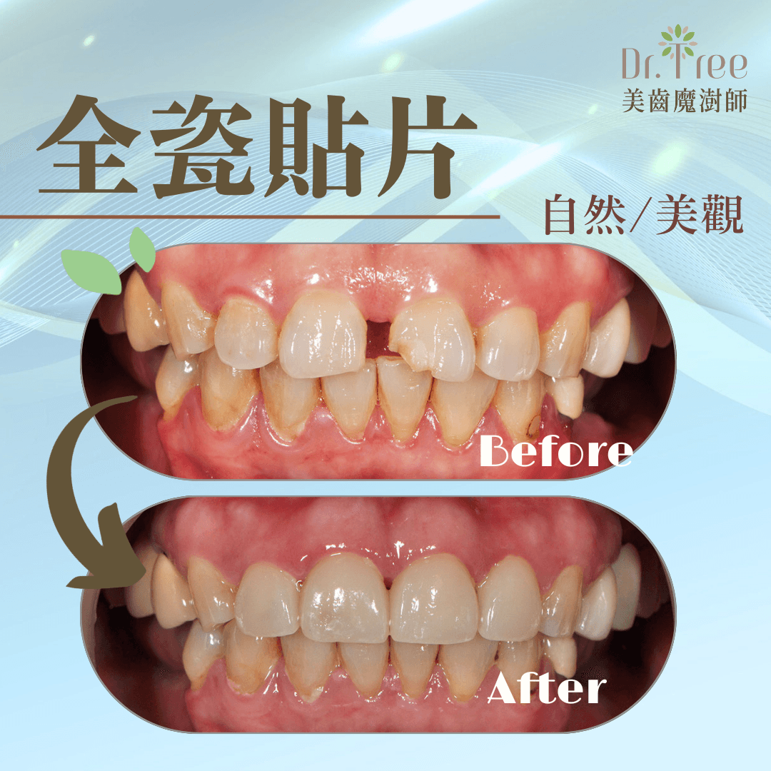 全瓷貼片案例 - Dr.Shuh 蔡忠澍醫師 土城牙醫｜牙齒重建專家