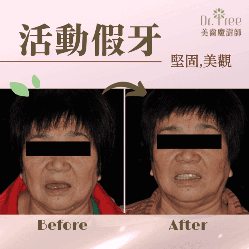 活動假牙 范小姐
